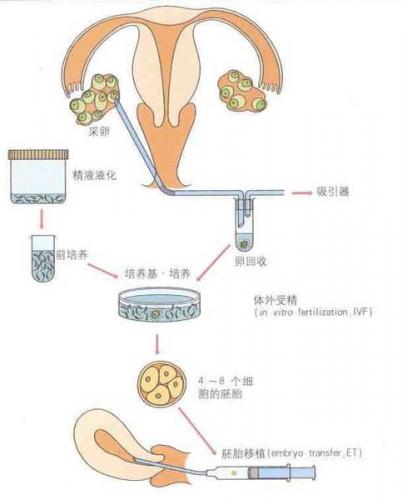 供卵试管婴儿双胞胎34周可以剖腹产-供卵试管婴儿双胞胎34周可以剖腹产